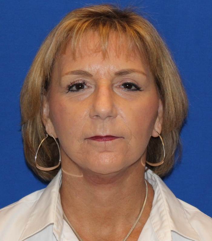 Blepharoplasty after