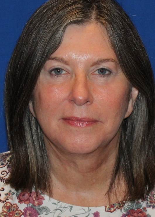 Blepharoplasty patient after, front view