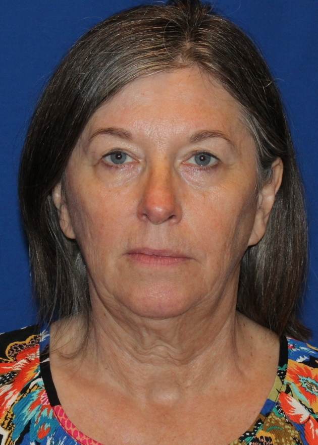Blepharoplasty patient before, front view