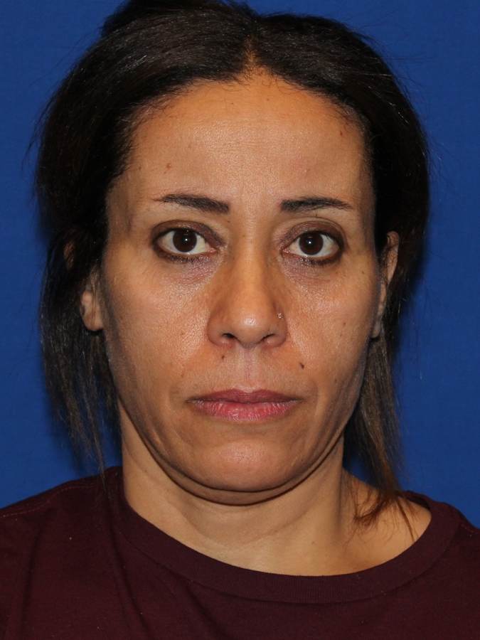 Cheek Implant patient after, front view