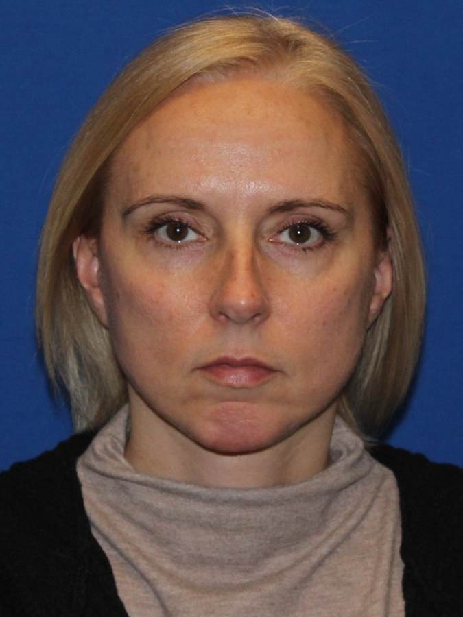 Chin Implant patient after, front view