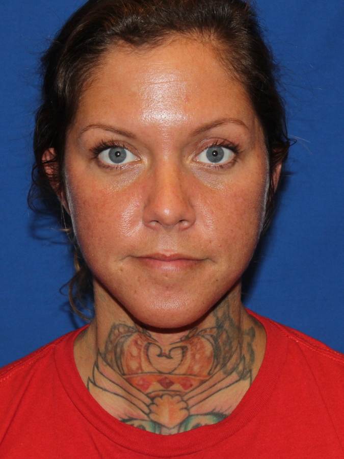 Facelift patient after, front view
