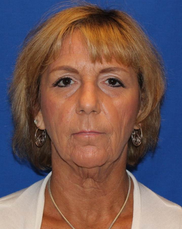 Facelift before