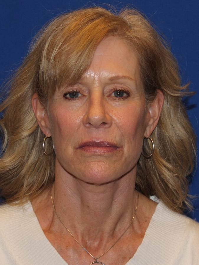 Facelift patient after, front view