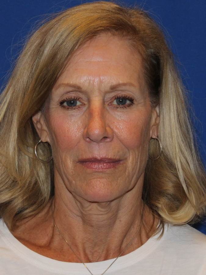 Facelift patient before, front view