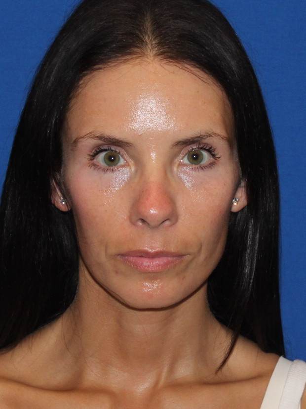 Facial Fat Transfer patient after, front view