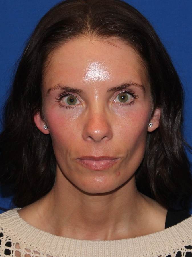 Facial Fat Transfer patient before, front view