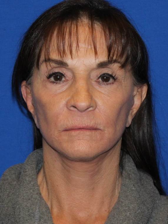 Laser skin resurfacing after