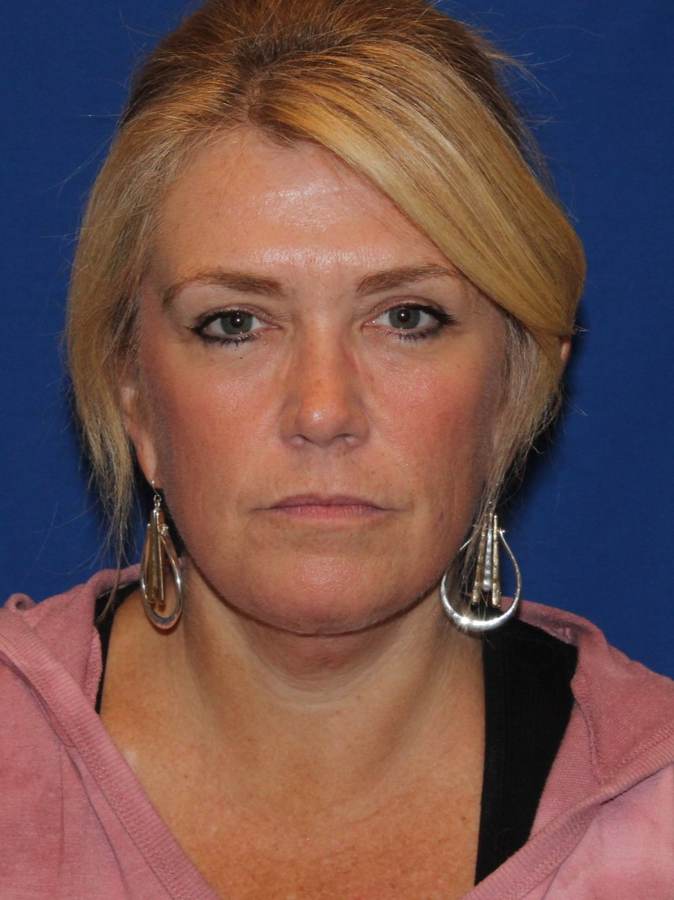 Neck liposculpting after