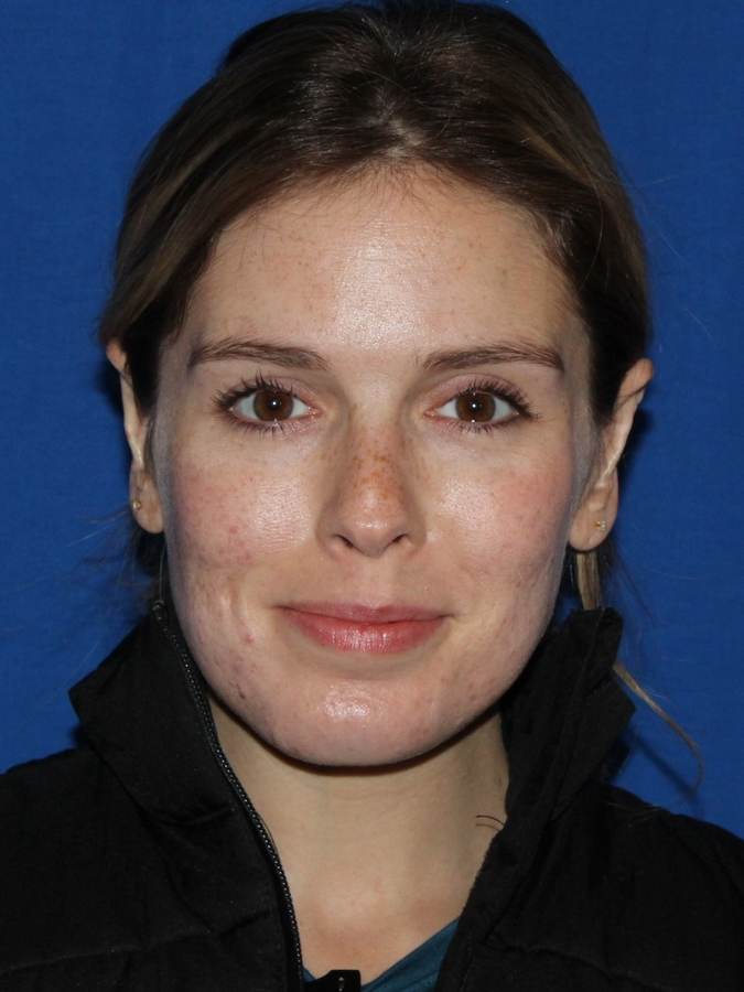 Otoplasty patient after, front view