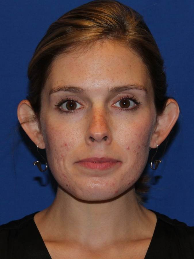Otoplasty patient before, front view