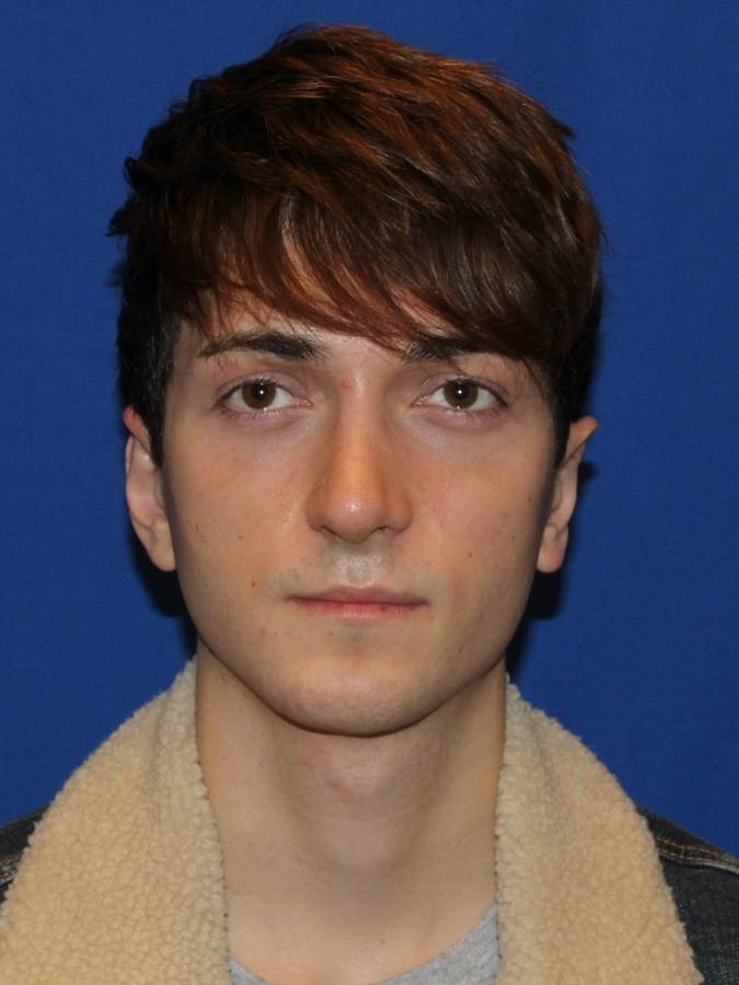 Otoplasty patient after, front view