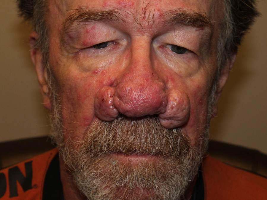 Rhinophyma Repair patient before, front view