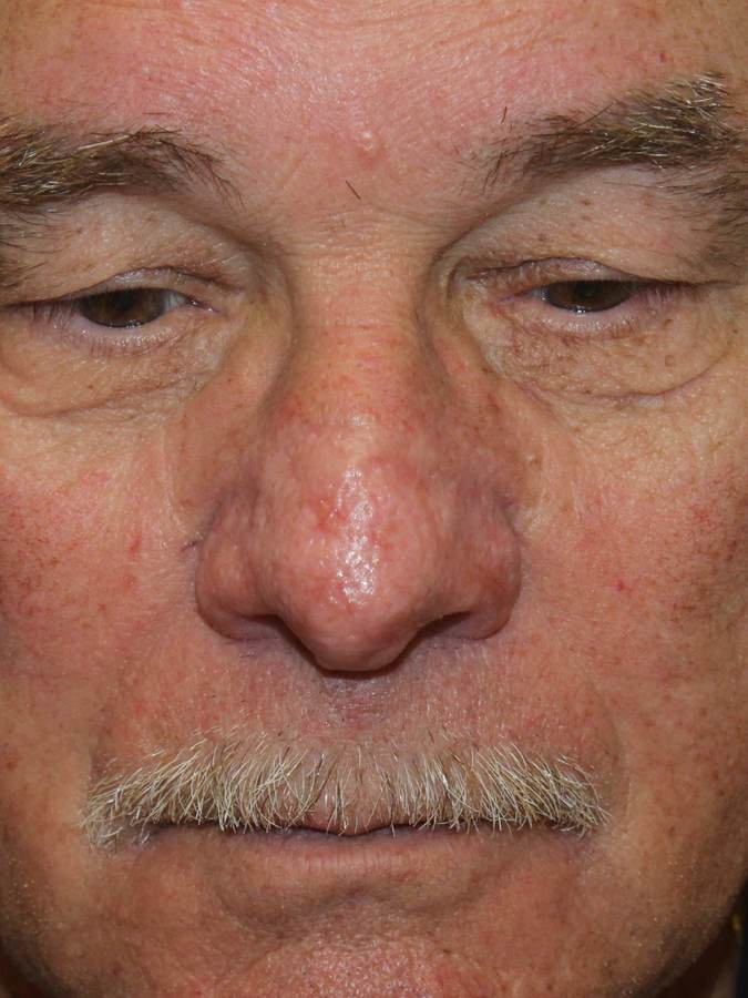 Rhinophyma after