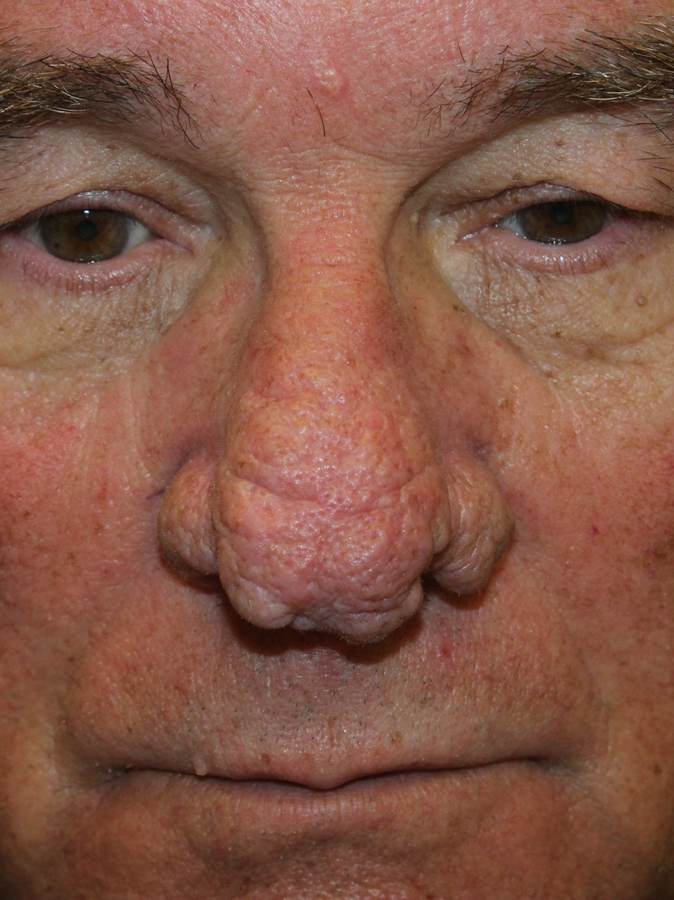 Rhinophyma before