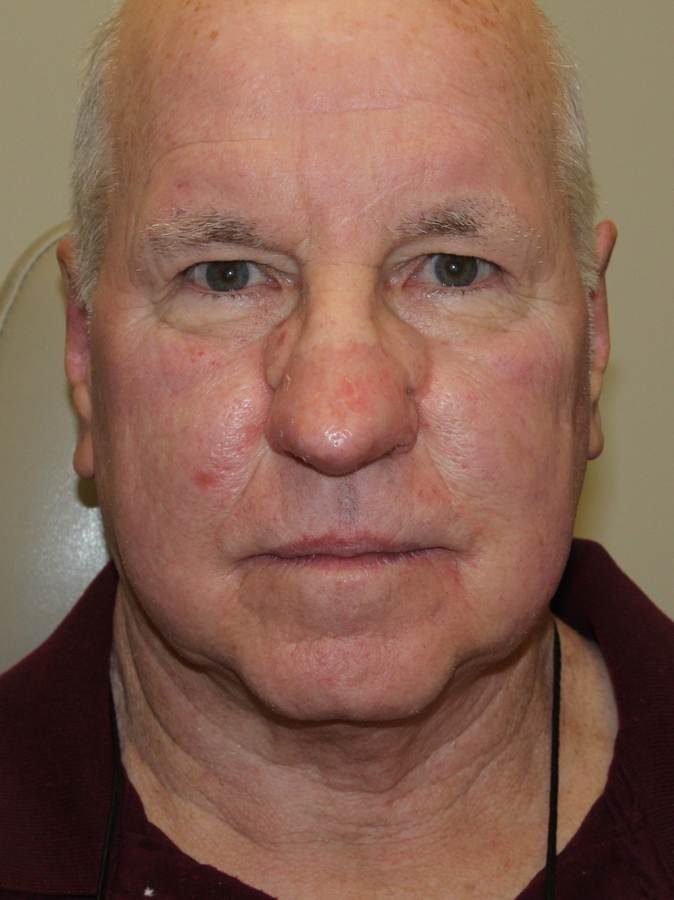 Rhinophyma Repair patient after, front view
