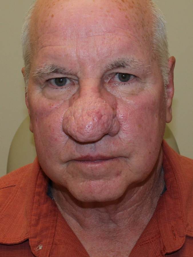 Rhinophyma Repair patient before, front view