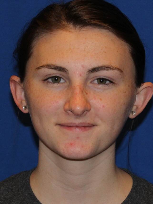 Rhinoplasty after