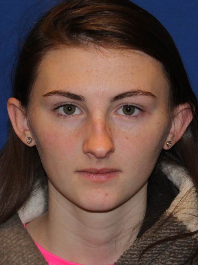 Rhinoplasty before