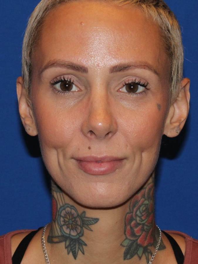 Rhinoplasty patient after, front view