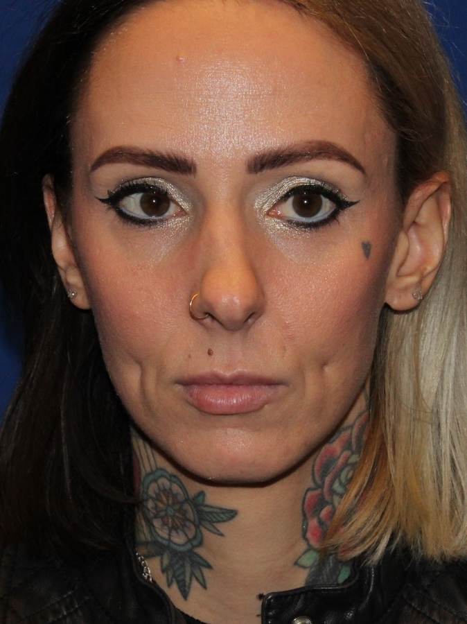 Rhinoplasty patient before, front view