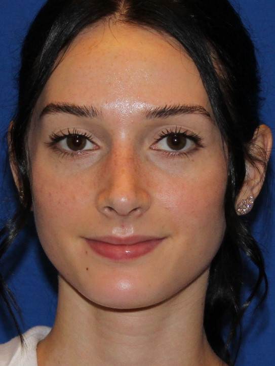 Rhinoplasty patient after, front view