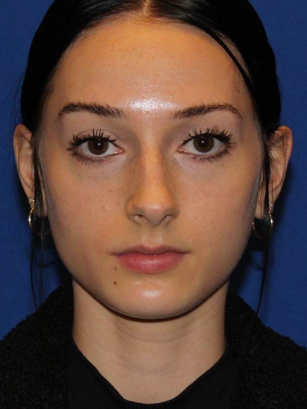 Rhinoplasty patient before, front view